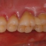 9 歯周病　炎症変化　前