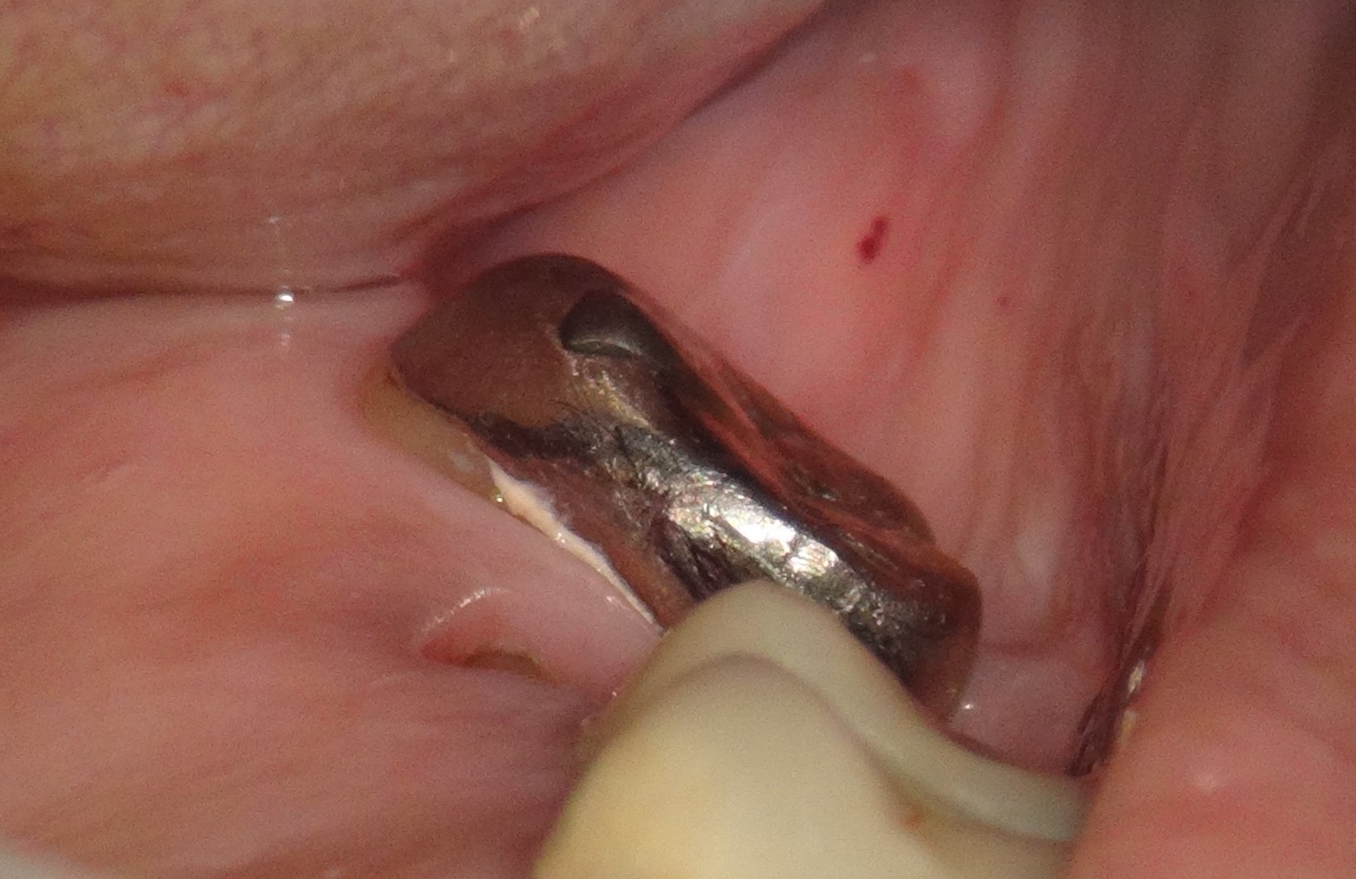 銀歯と歯の間の隙間