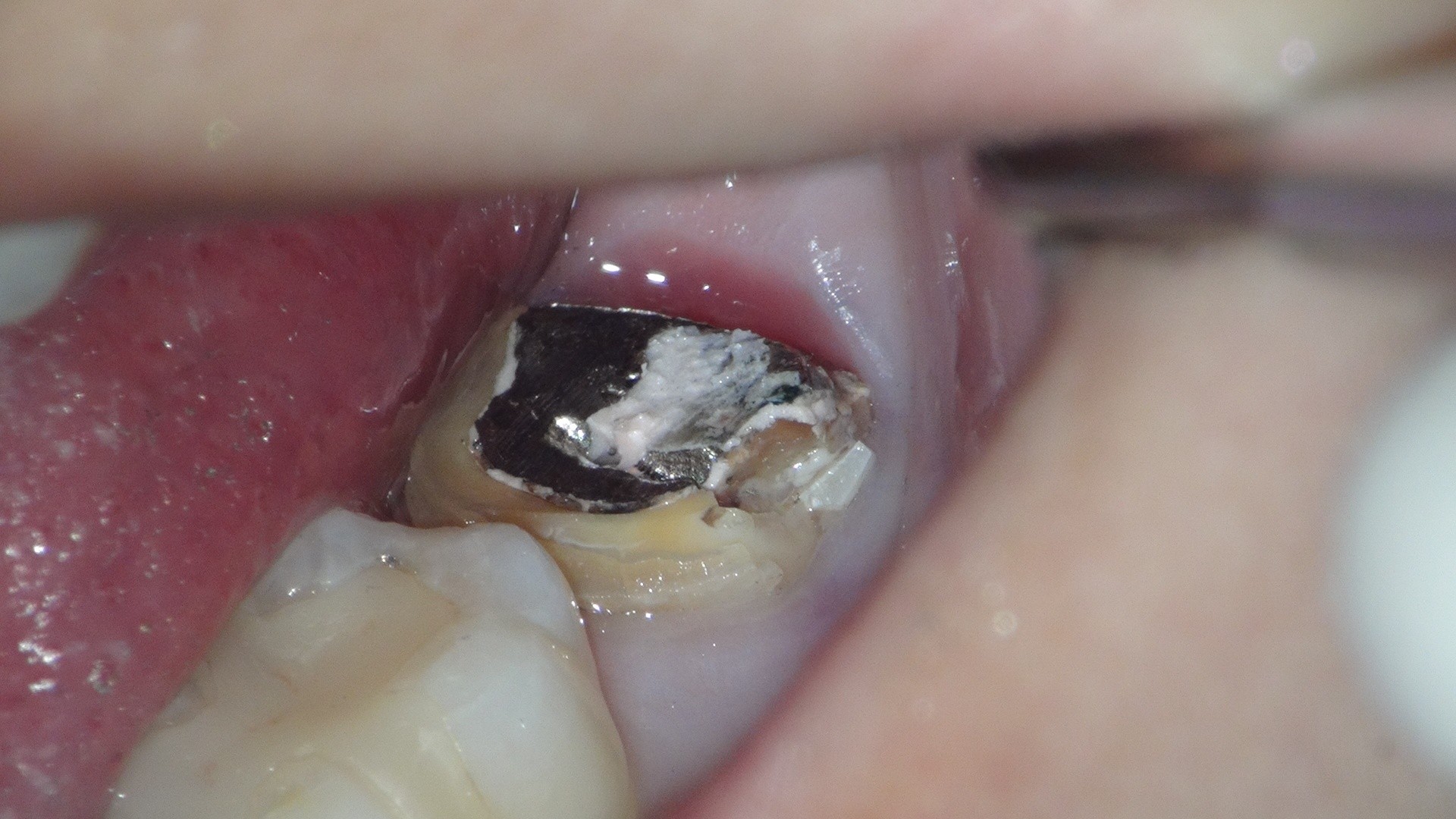 銀歯の下は虫歯（銀歯を取ったところ）
