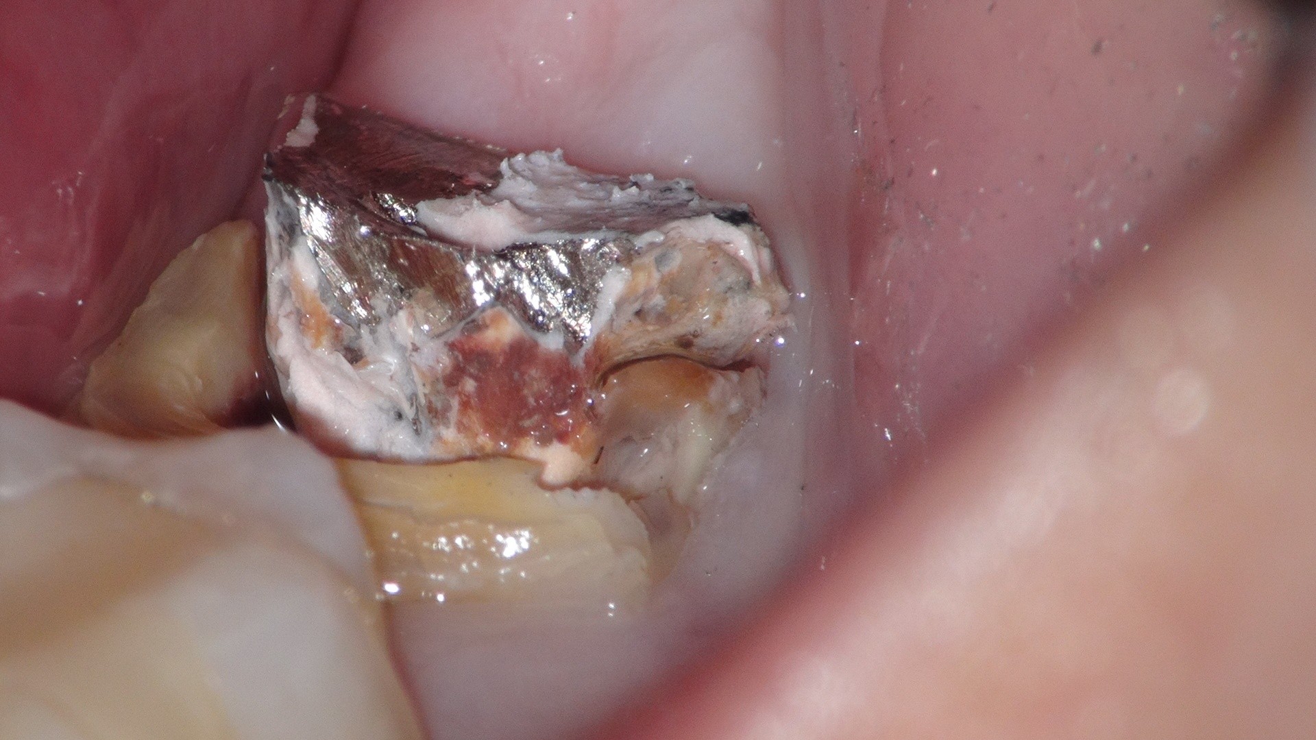 銀歯の下は虫歯（柱が取れてきたところ）