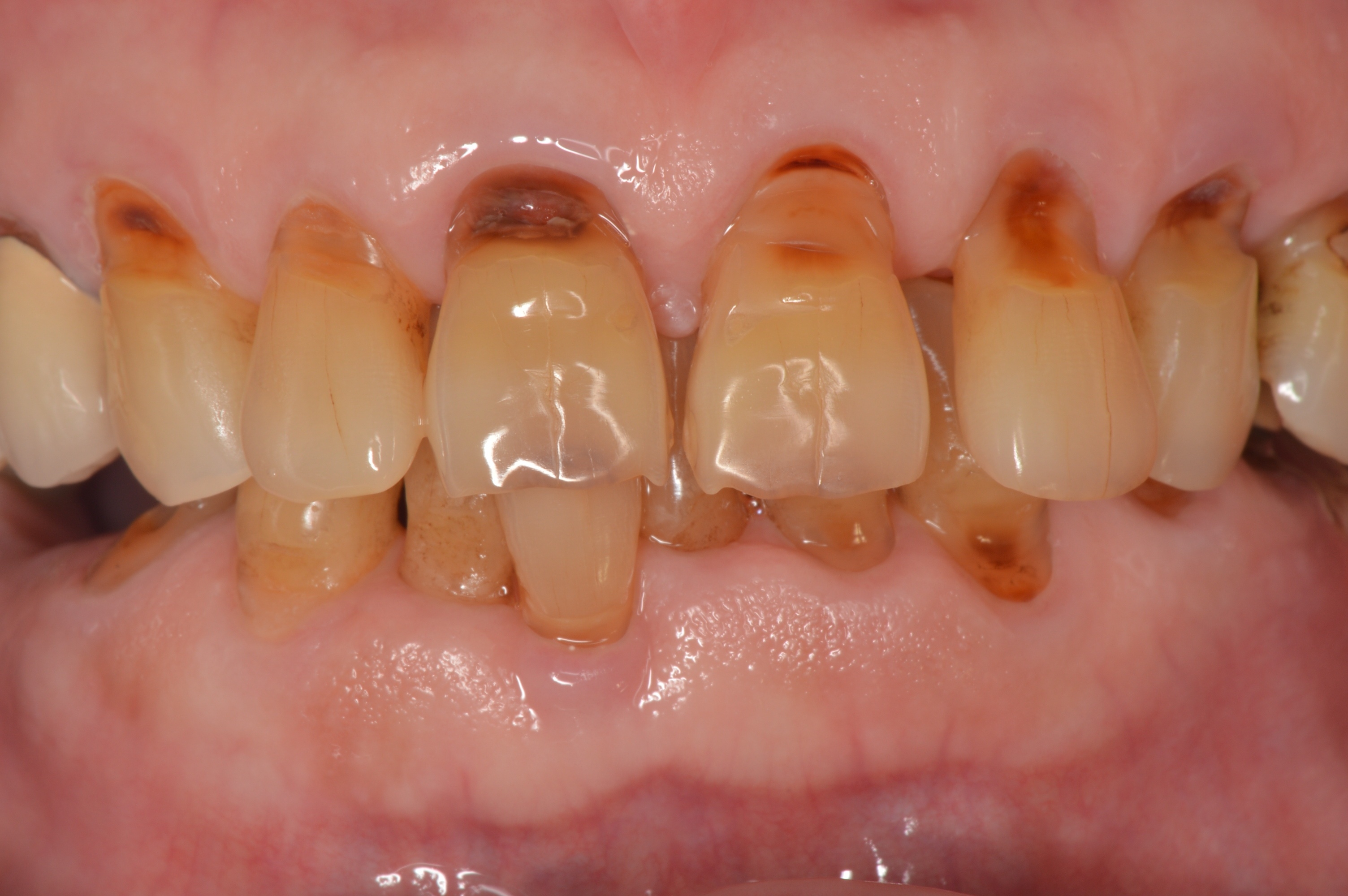 歯周病と歯茎の後退