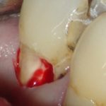 C3虫歯取って腫れた歯髄が出血している