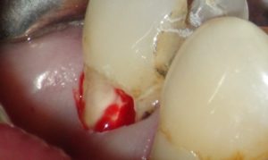 C3虫歯取って腫れた歯髄が出血している