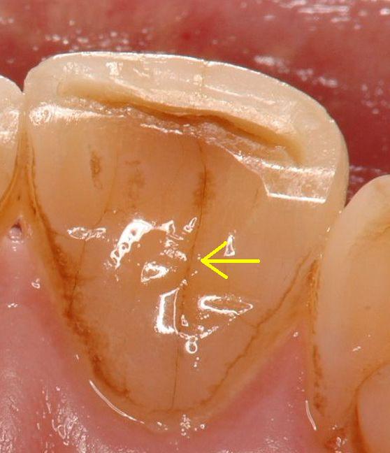 歯 の 根 ひび 症状