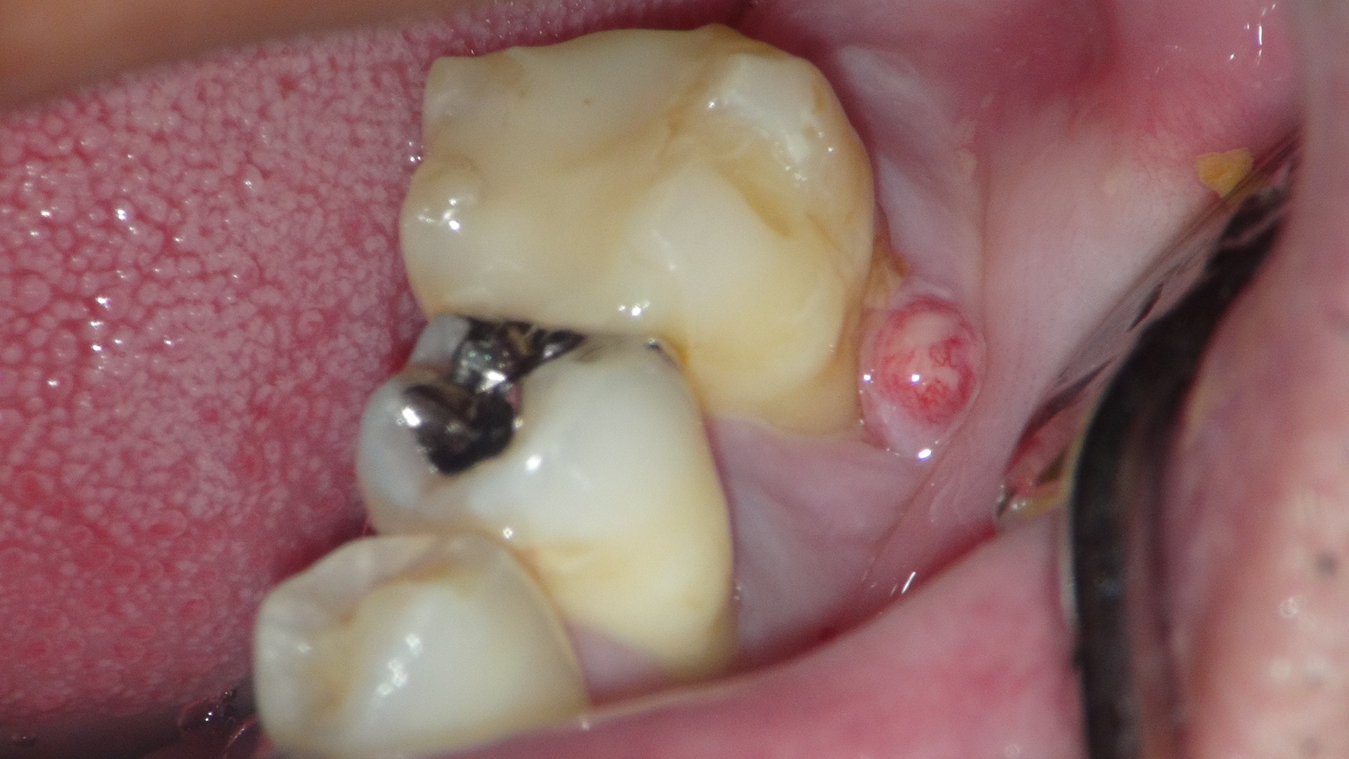 の 方 出し の 腫れ 膿 歯茎